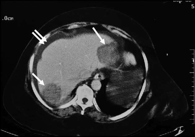 Prolonged survival in metastatic colorectal cancer following chemotherapy