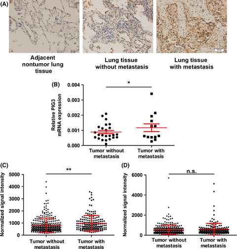 p53-inducible gene 3 promotes cell migration and invasion by activating the FAK/Src pathway in lung adenocarcinoma