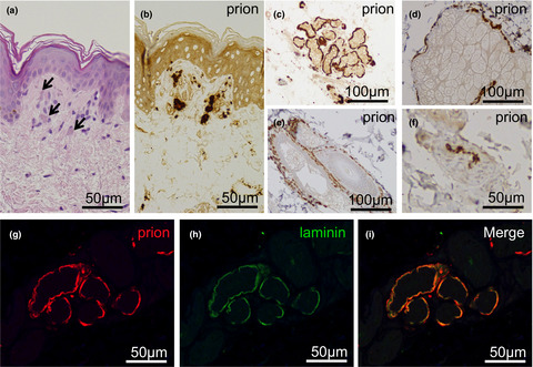 Detection of cutaneous prion protein deposits could help diagnose GPI-anchorless prion disease with neuropathy