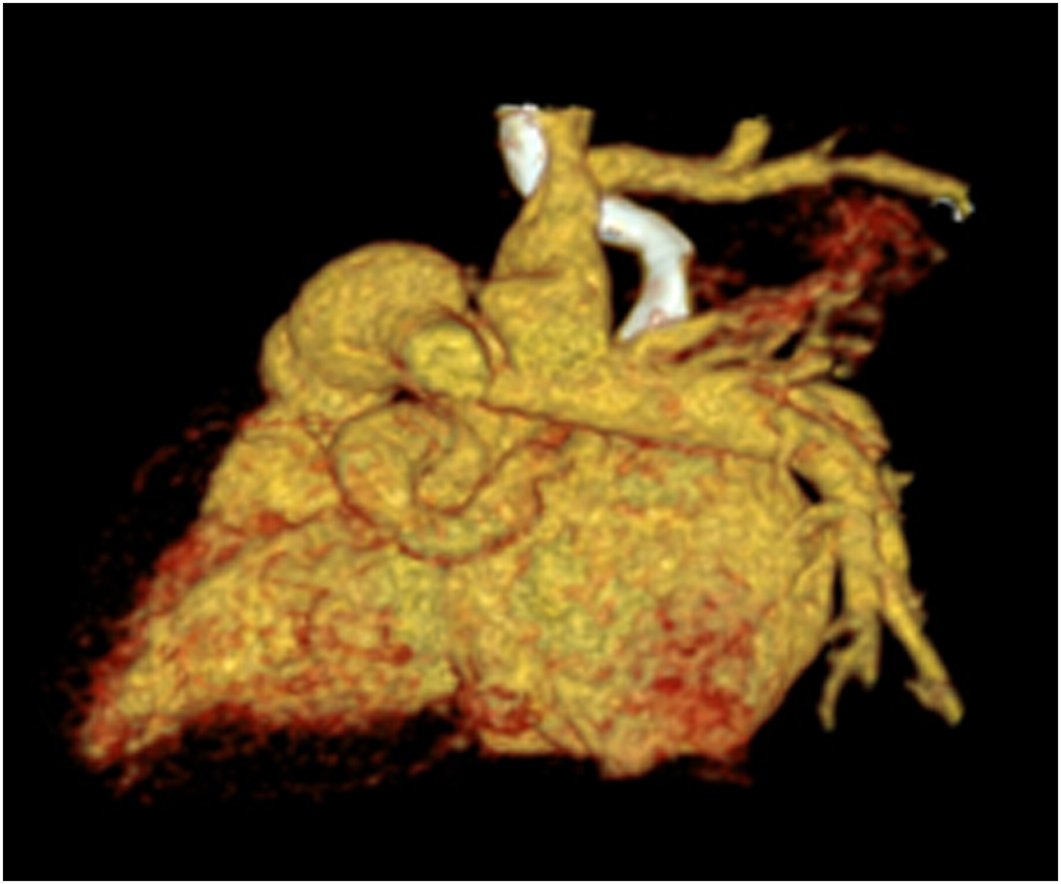Aorta–Right Atrial Tunnel in Conjunction With Patent Ductus Arteriosus and Atrial Septal Defect