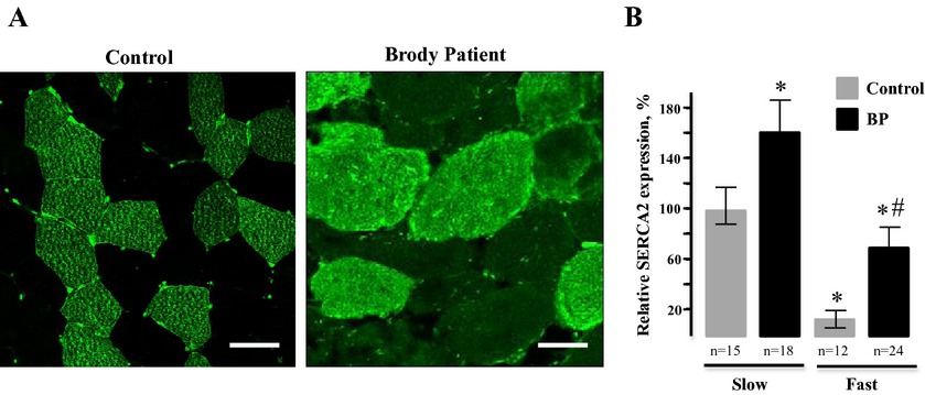 Exome analysis identifies Brody myopathy in a family diagnosed with malignant hyperthermia susceptibility