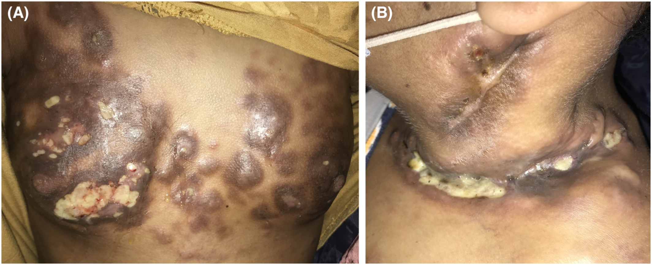 Relapse of Hodgkin's disease revealed by skin involvement