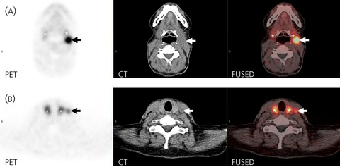 Misleading 68GALLIUM-dotatate PET scan in a patient with a history of a phaeochromocytoma: Unsuspected uptake in papillary thyroid carcinoma metastases