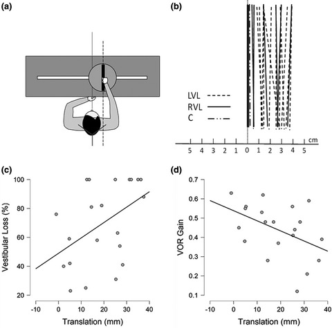 Signs of spatial neglect in unilateral peripheral vestibulopathy