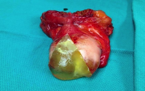 Incidentally discovered low-grade appendiceal mucinous neoplasm: a precursor to pseudomyxoma peritonei