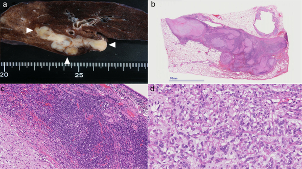 Angiomatoid fibrosis histiocytoma in the pulmonary artery: A case report