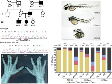 A novel variant in AFF3 underlying isolated syndactyly