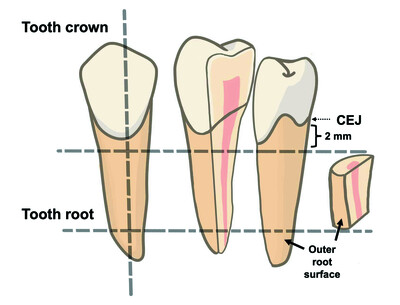 Synchrotron radiation analysis of root dentin: the roles of fluoride and calcium ions in hydroxyapatite remineralization