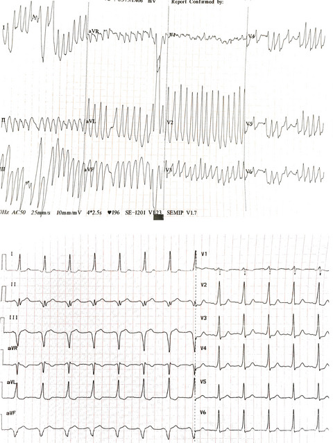 Atrial fibrillation and Wolff–Parkinson–White syndrome: A double blow for the cardiologist
