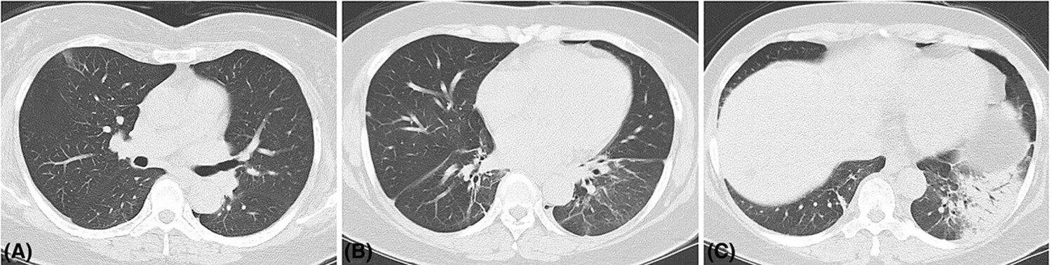Clinical features and outcome of eight patients with Chlamydia psittaci pneumonia diagnosed by targeted next generation sequencing