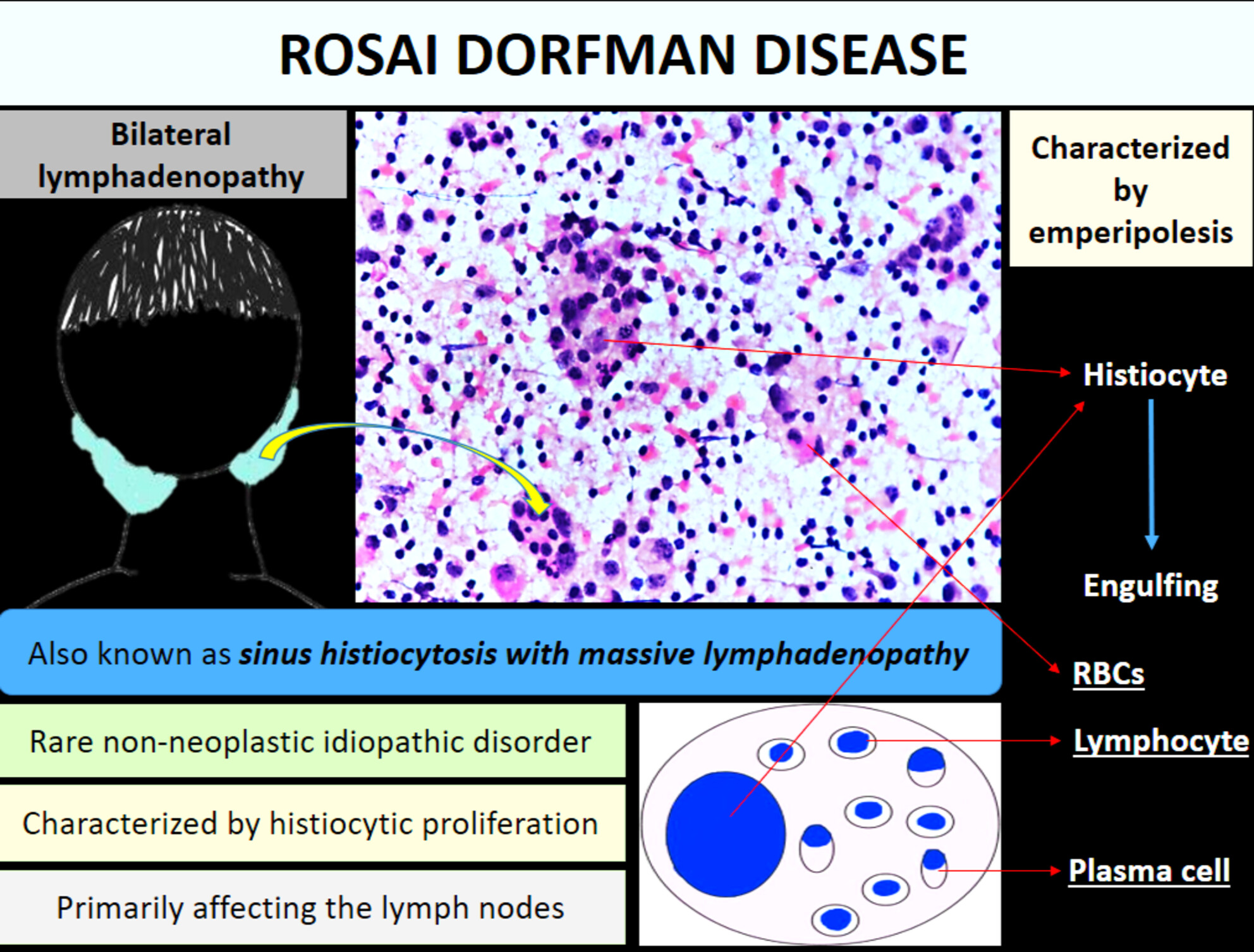 Cytology of Bilateral Lymph Nodal Masses in a Young Adult