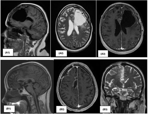 Selective interstitial doxorubicin for recurrent glioblastoma