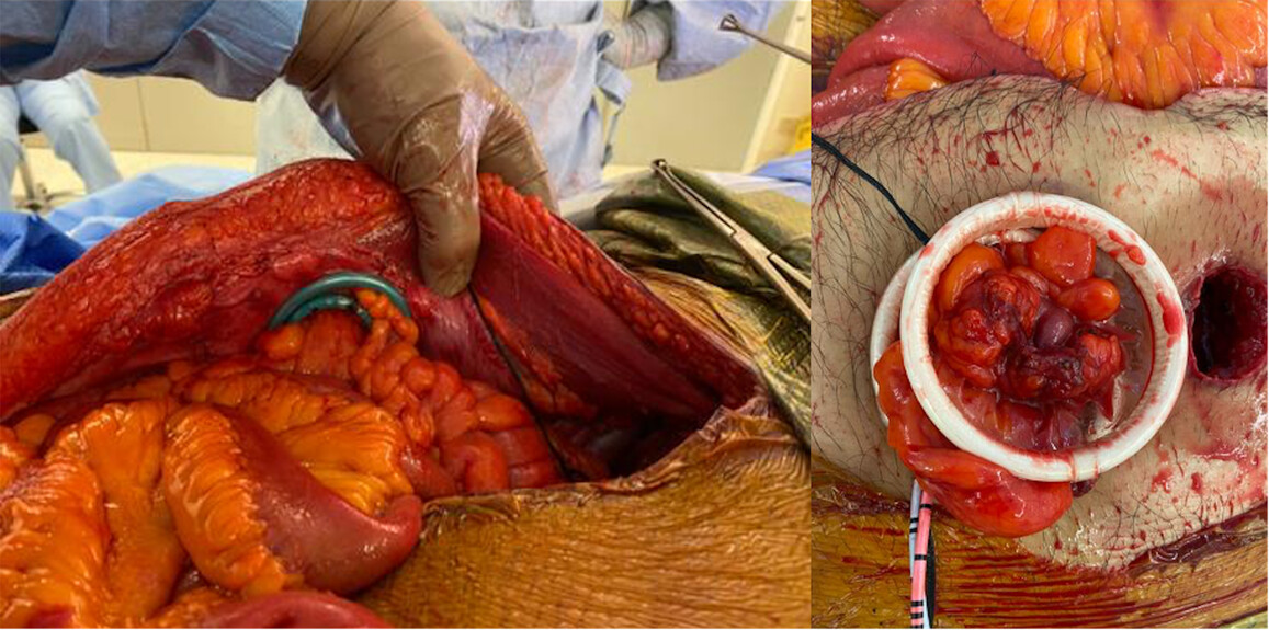 A single centre experience on the formation of double barrelled uro-colostomy in pelvic exenteration surgery: a cohort study