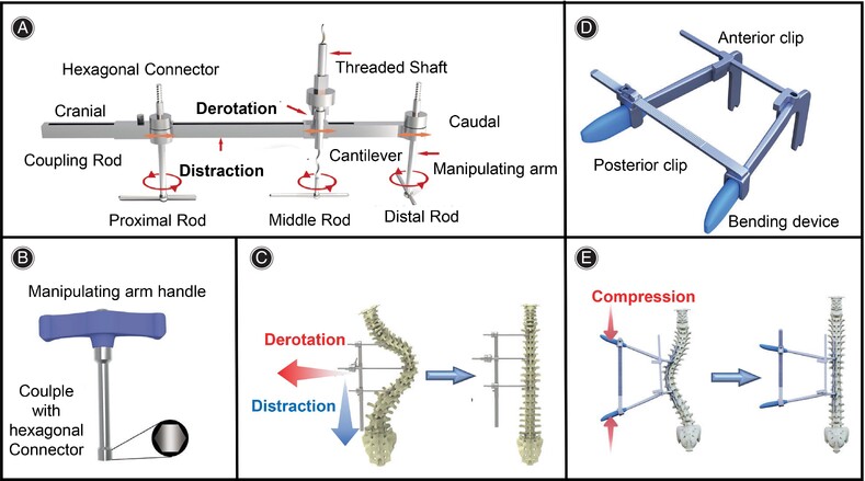 A Novel Deformity Correction Manipulation System for Better Correction of Large Thoracic Scoliosis