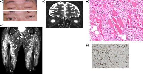 Fatal fulminant inflammation in the diaphragm resulting from pembrolizumab-related myopathy