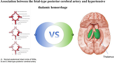 Association Between the Fetal-Type Posterior Cerebral Artery and Hypertensive Thalamic Hemorrhage