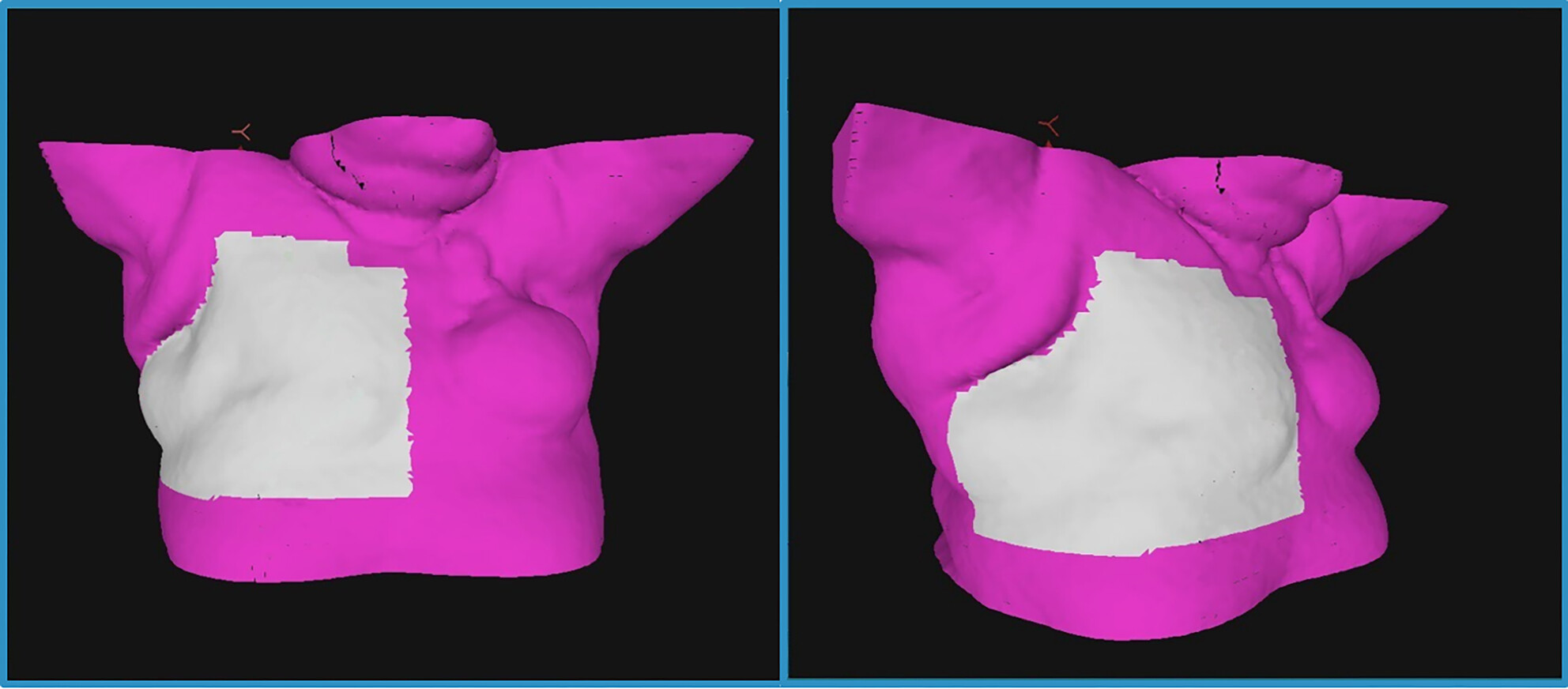 The impact of a prophylactic skin dressing on surface-guided patient positioning in chest wall Radiation Therapy