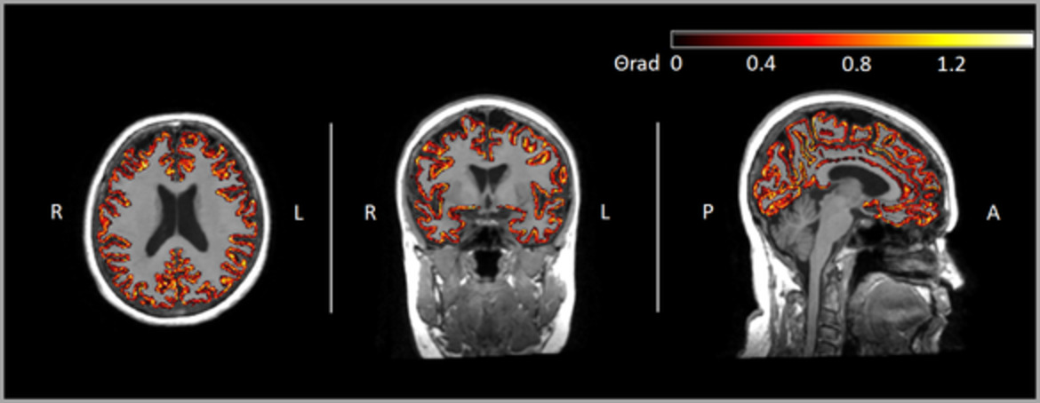 Detection of Alzheimer's Disease using cortical diffusion tensor imaging