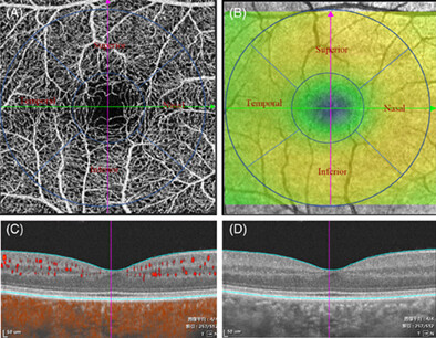Microvasculature and microstructure alteration in dry-type high myopia