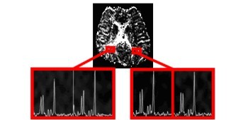 Reduction of N-acetyl Aspartate in Bilateral Cerebral Tissue in Relation to Compromised Cerebrovascular Reserve Capacity as Investigated by Proton MR Spectroscopy and Acetazolamide Test