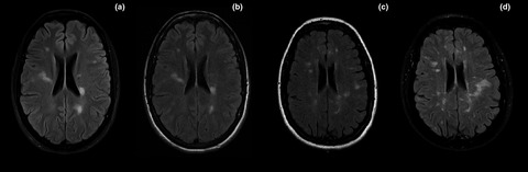 Pregnancy in multiple sclerosis: A reflection on the importance of individualizing management