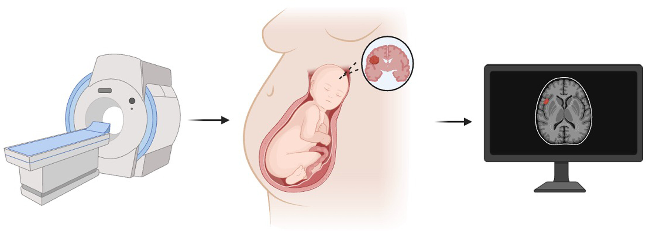 Congenital Intracranial Tumors: Prenatal Diagnosis by Fetal Magnetic Resonance Imaging
