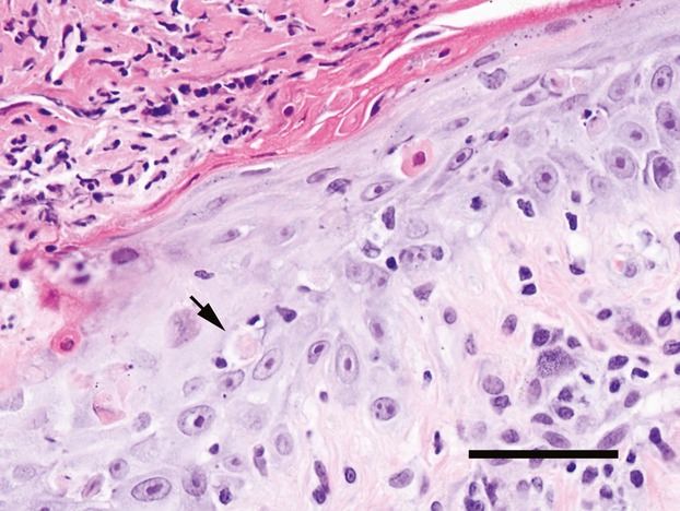 Erythema multiforme associated with zonisamide in a dog