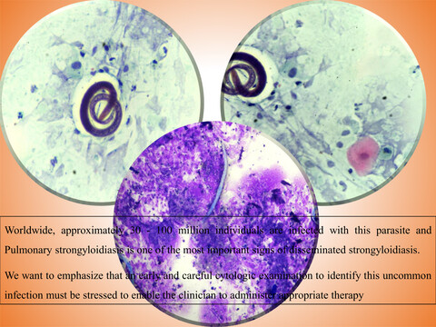 Parasitic larvae in bronchoalveolar lavage fluid in a non-immunocompromised patient