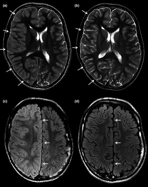 Sudden death in epilepsy: There is room for intracranial pressure