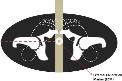 Pre-operative templating for total hip arthroplasty: How does radiographic technique and calibration marker placement affect image magnification?