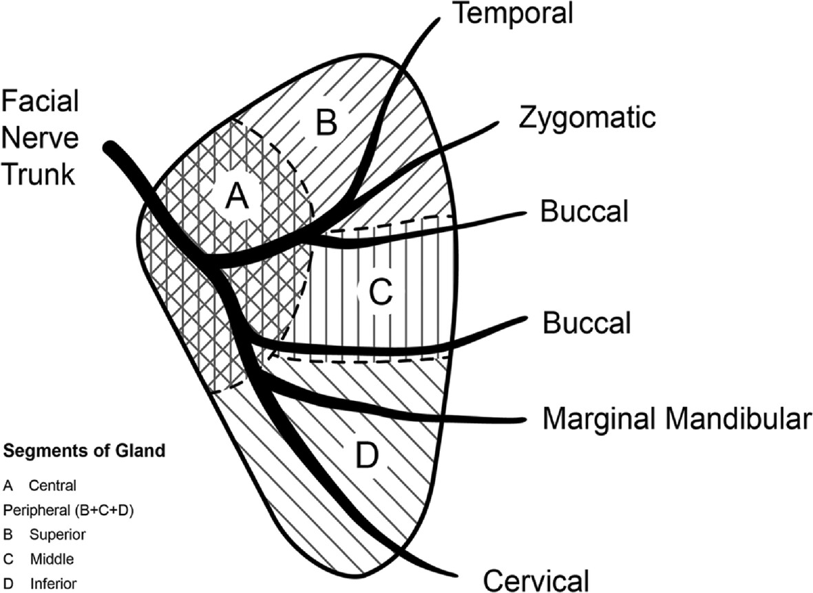 Outcomes of a modified technique of partial parotidectomy and novel parotid tumour position classification from a single surgeon prospective database