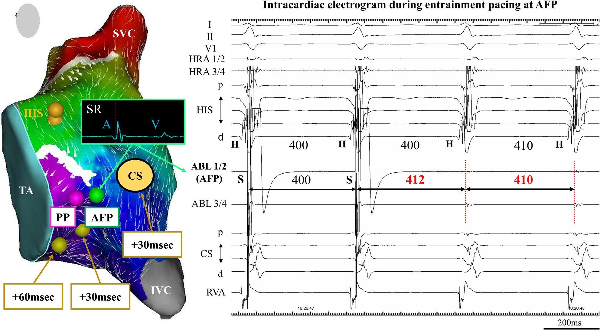 A novel ablation strategy of slow/fast atrioventricular nodal reentrant tachycardia targeting the atrial activation focusing point at the inferior Koch's triangle: Identification of entrance site of slow pathway using high-resolution 3D mapping