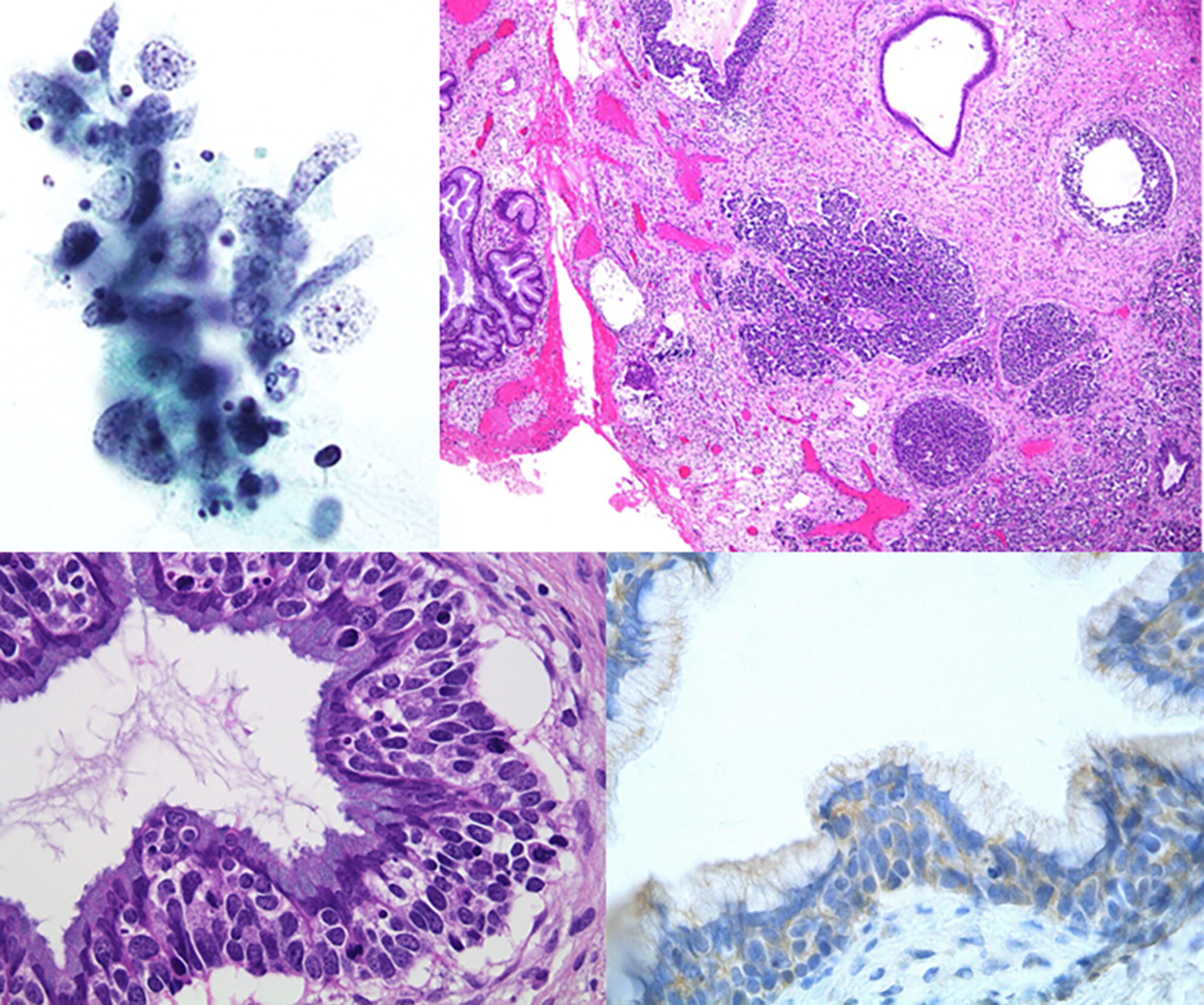 Large Cell Neuroendocrine Carcinoma of the Uterine Cervix With a Biphasic Synaptophysin Staining Pattern and Followed Vaginal Intraepithelial Recurrence: A Case Report