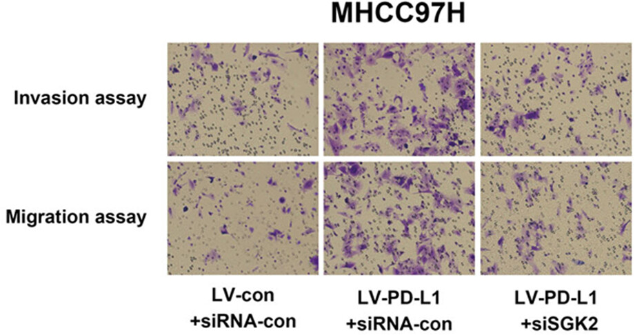 Programmed death ligand 1 regulates epithelial–mesenchymal transition and cancer stem cell phenotypes in hepatocellular carcinoma through the serum and glucocorticoid kinase 2/β-catenin signaling pathway
