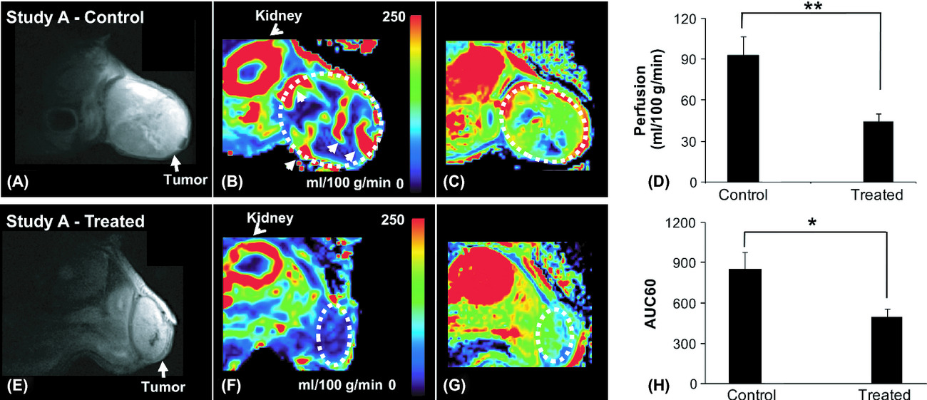 Early detection of antiangiogenic treatment responses in a mouse xenograft tumor model using quantitative perfusion MRI