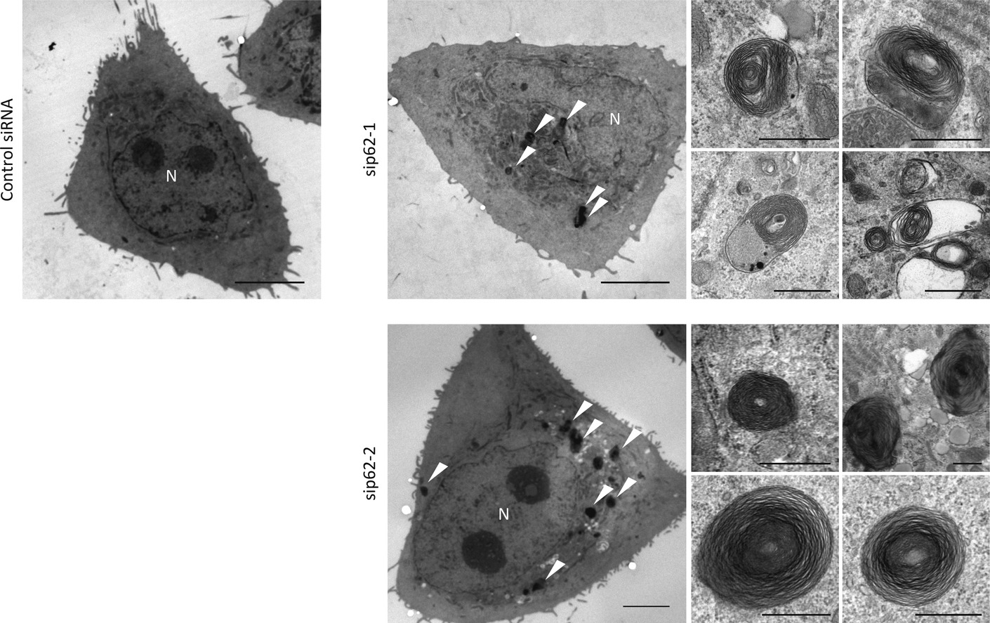 An inhibition of p62/SQSTM1 caused autophagic cell death of several human carcinoma cells