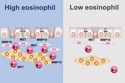 Contribution of airway eosinophils in airway wall remodeling in asthma: Role of MMP-10 and MET