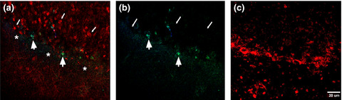 Treatment-responsive primary autoimmune cerebellar ataxia in a patient with IgG and IgM anticerebellar antibodies