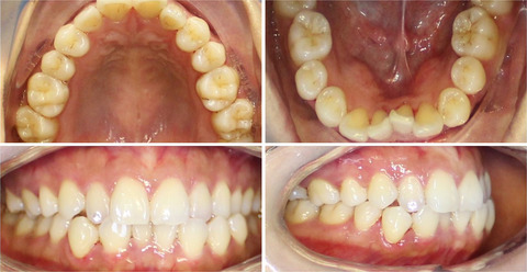 Rare non-syndromic bilateral maxillary and mandibular permanent canine agenesis