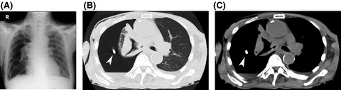 Spontaneous pneumothorax due to bronchopleural fistula following reirradiation for locoregionally recurrent squamous cell lung cancer