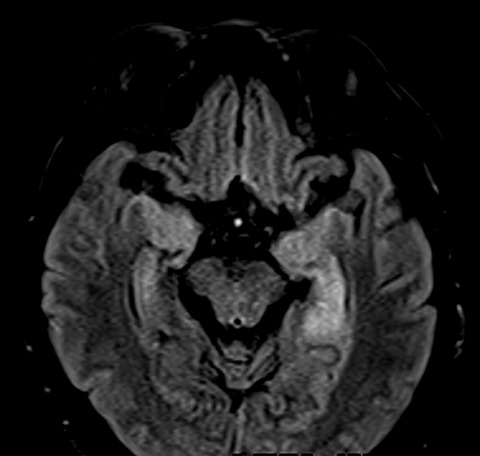 Voltage-gated potassium channel complex (VGKC) antibody encephalitis in a Filipino adult: A reversible cause of early-onset neurocognitive disorder