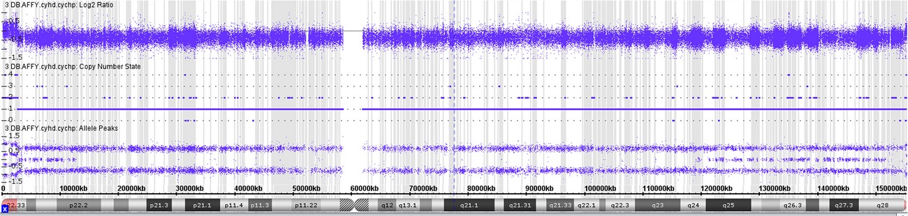 Digynic triploidy: utility and challenges of noninvasive prenatal testing