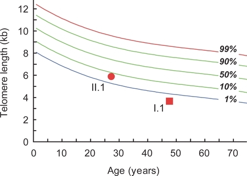 Telomere Phenotypes in Females with Heterozygous Mutations in the Dyskeratosis Congenita 1 (DKC1) Gene