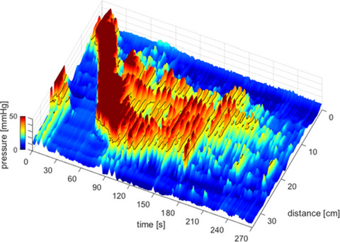The cyclic motor patterns in the human colon