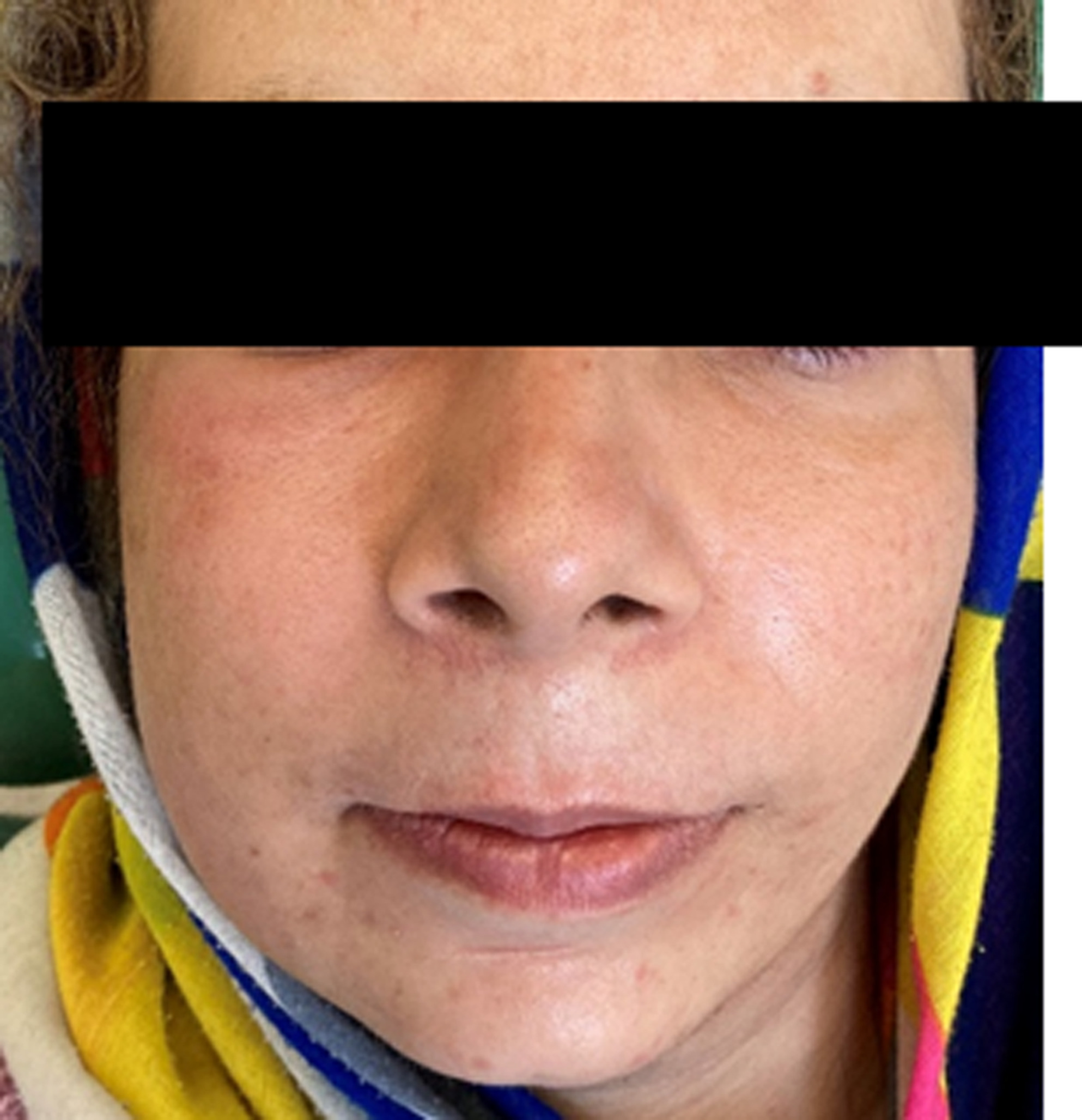 Injectable soft tissue filler infection with a similar appearance to an odontogenic abscess
