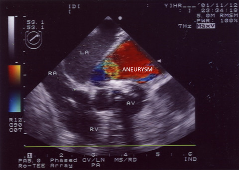 Intraoperative diagnosis of an unsuspected ruptured left ventricular aneurysm using transesophageal echocardiography: A case report