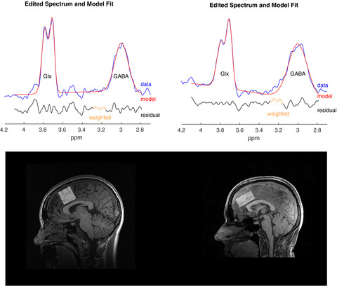 Anterior cingulate gamma-aminobutyric acid concentrations and electroconvulsive therapy