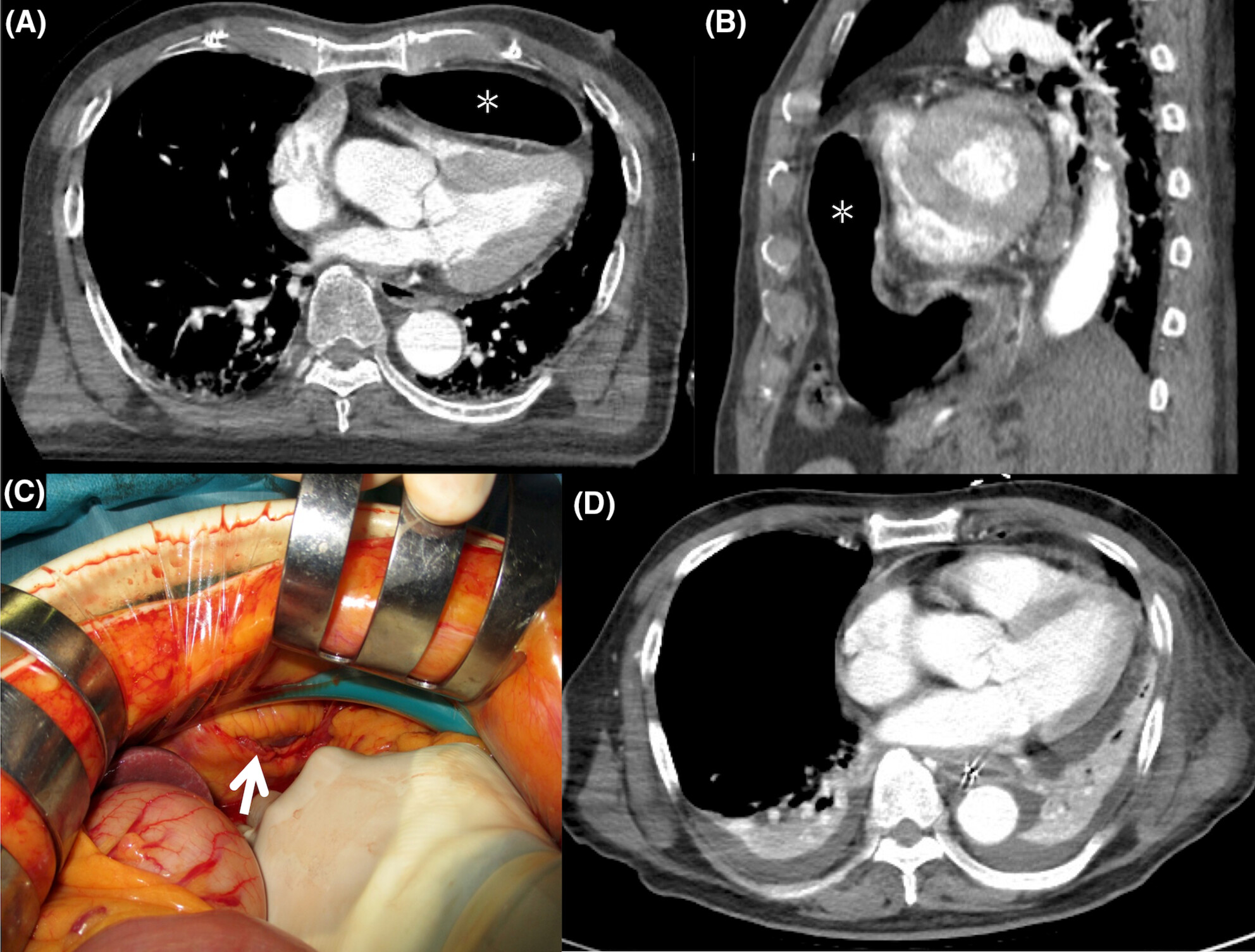 Traumatic intrapericardial diaphragmatic hernia
