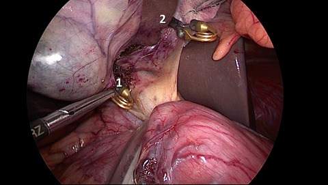 Standardized laparoscopic central hepatectomy based on hilar caudal view and root approach of the right hepatic vein
