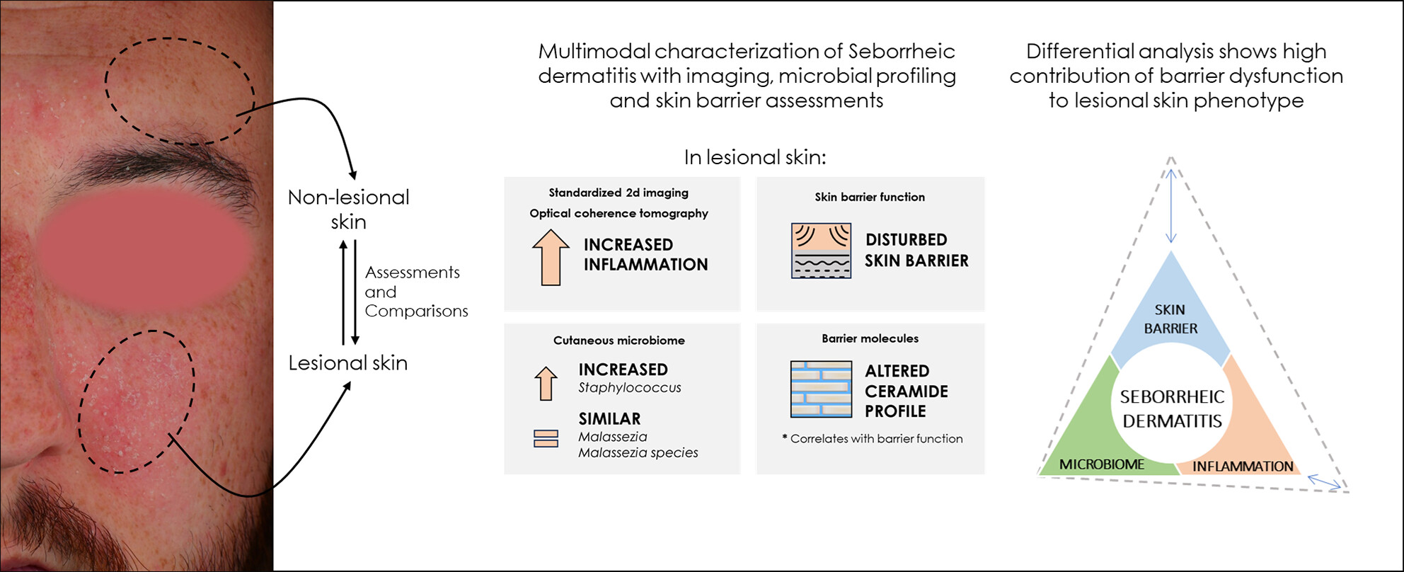 Lesional skin of seborrheic dermatitis patients is characterized by skin barrier dysfunction and correlating alterations in the stratum corneum ceramide composition